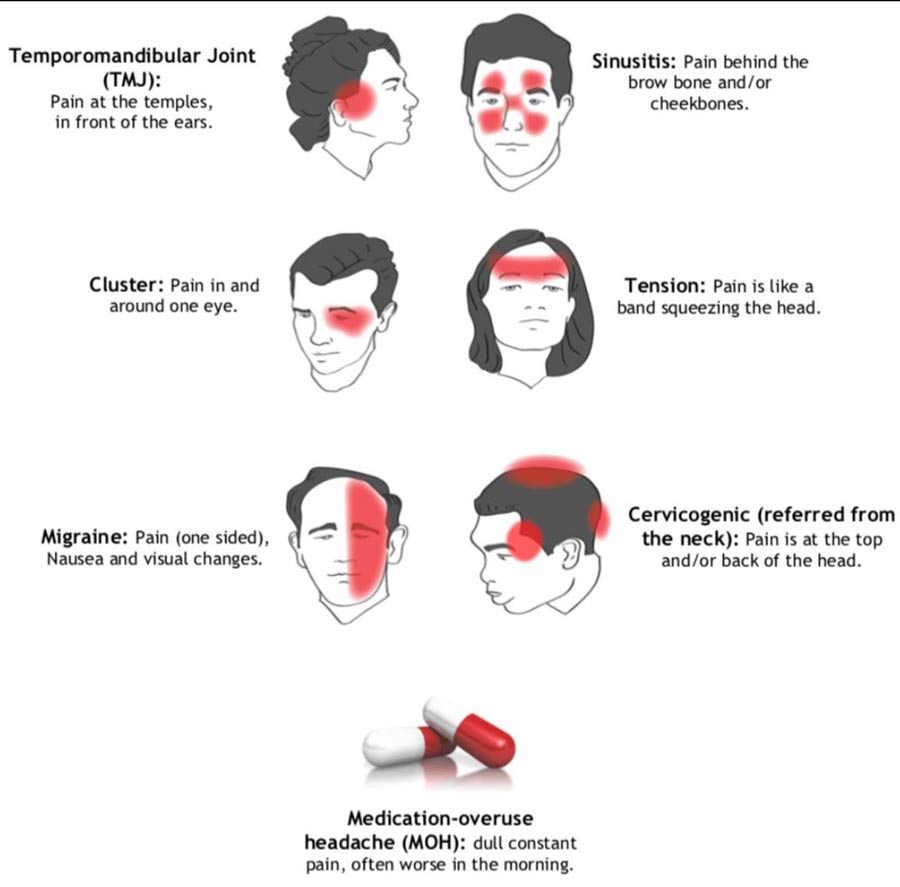 headache types explained with meanings